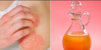 How To Use Apple Cider Vinegar For Psoriasis? Apple Cider Vinegar For Psoriasis