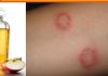 How to Use Apple Cider Vinegar For Ringworm? Apple Cider Vinegar For Ringworm