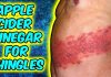 How To Use Apple Cider Vinegar For Shingles? Apple Cider Vinegar For Shingles