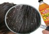 How To Use Apple Cider Vinegar For Dandruff? Apple cider vinegar for dandruff