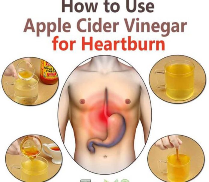 Apple cider vinegar for heartburn