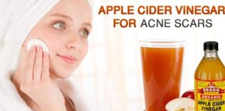 How To Use Apple Cider Vinegar For Acne Scars? Apple cider vinegar for acne scars