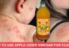 How To Use Apple Cider Vinegar For Eczema? how to use apple cider vinegar for eczema