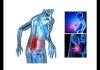 Symptoms of Multiple Myeloma Symptoms of Multiple Myeloma