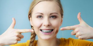 Here’s What the Process of Getting Braces Looks Like Process of Getting Braces