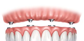 Houston Residents: Find Out How to Get Affordable Dental Implants Affordable Dental Implants