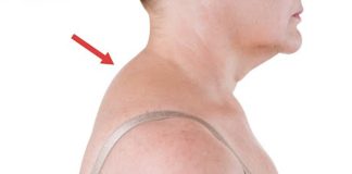 How to Get Rid of Dowager’s Hump Easily get rid of dowager's hump