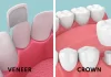 Veneers vs. Crowns