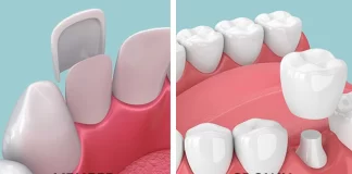 Veneers vs. Crowns